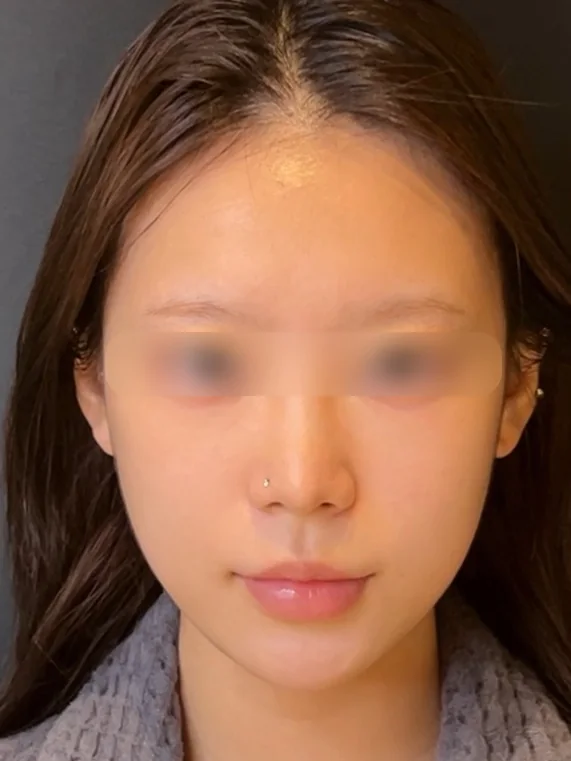 ONDA + Ultherapy after treatment