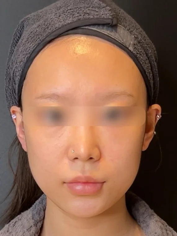ONDA + Ultherapy before treatment