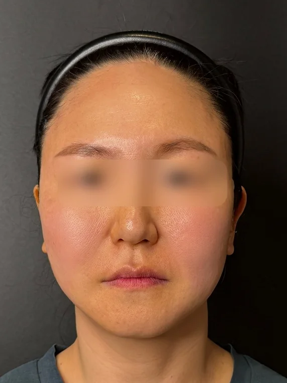 APTOS after treatment
