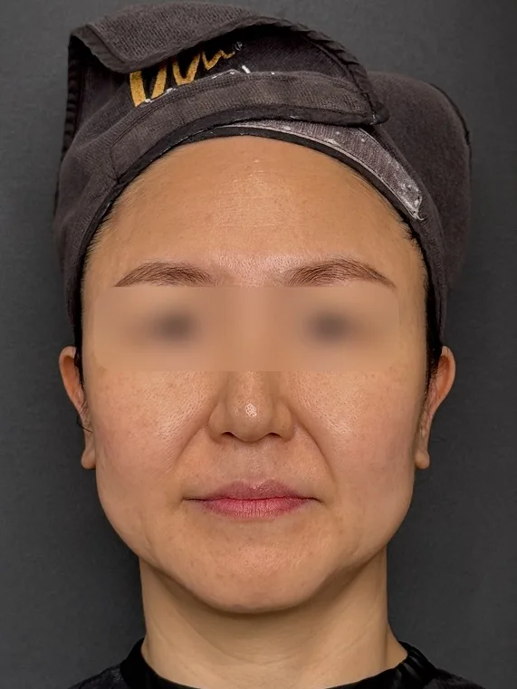 APTOS before treatment