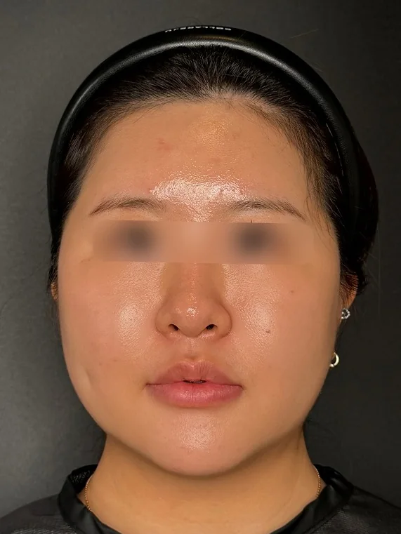 APTOS (double chin) after treatment