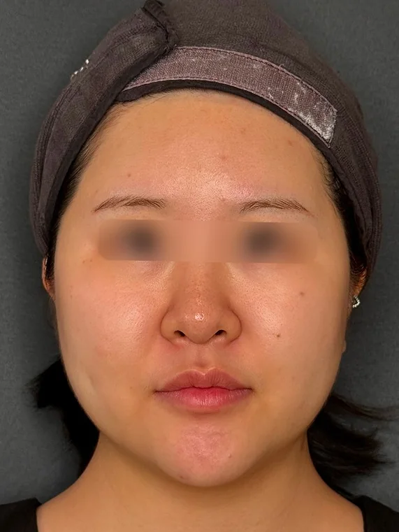 APTOS (double chin) before treatment