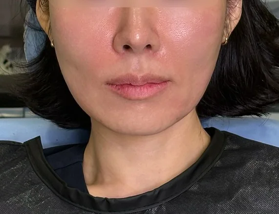 벨루티 + 스컬트라 시술 후