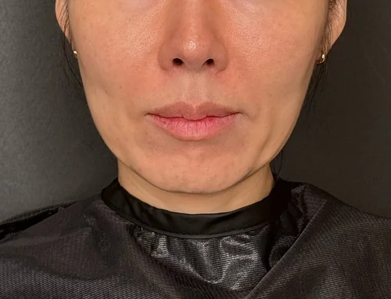 벨루티 + 스컬트라 시술 전