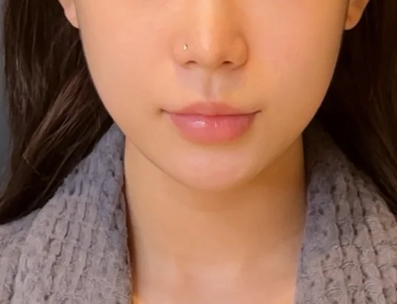 온다 + 울쎄라 시술 후