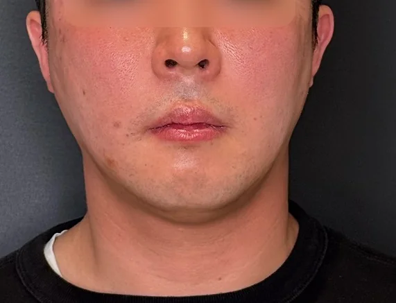 압토스 + 리스템셀 시술 후