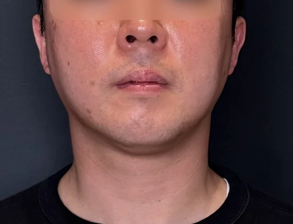압토스 + 리스템셀 시술 전
