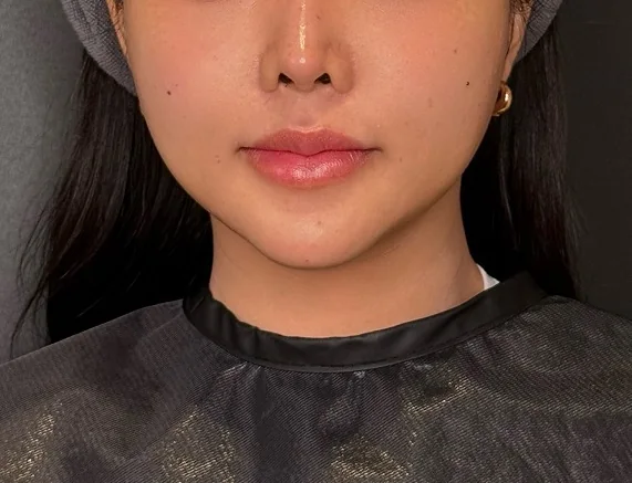 라풀렌 시술 후