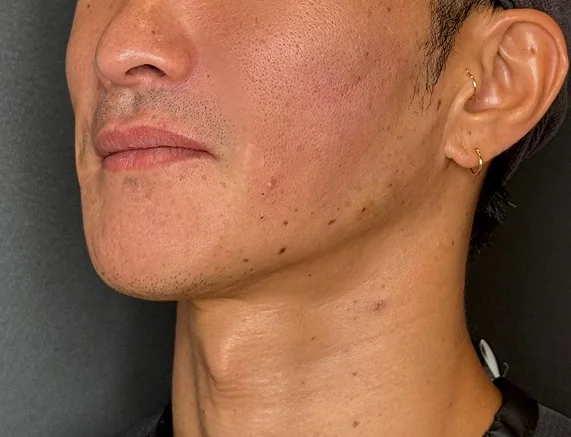 라풀렌 시술 후