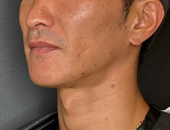 라풀렌 시술 전
