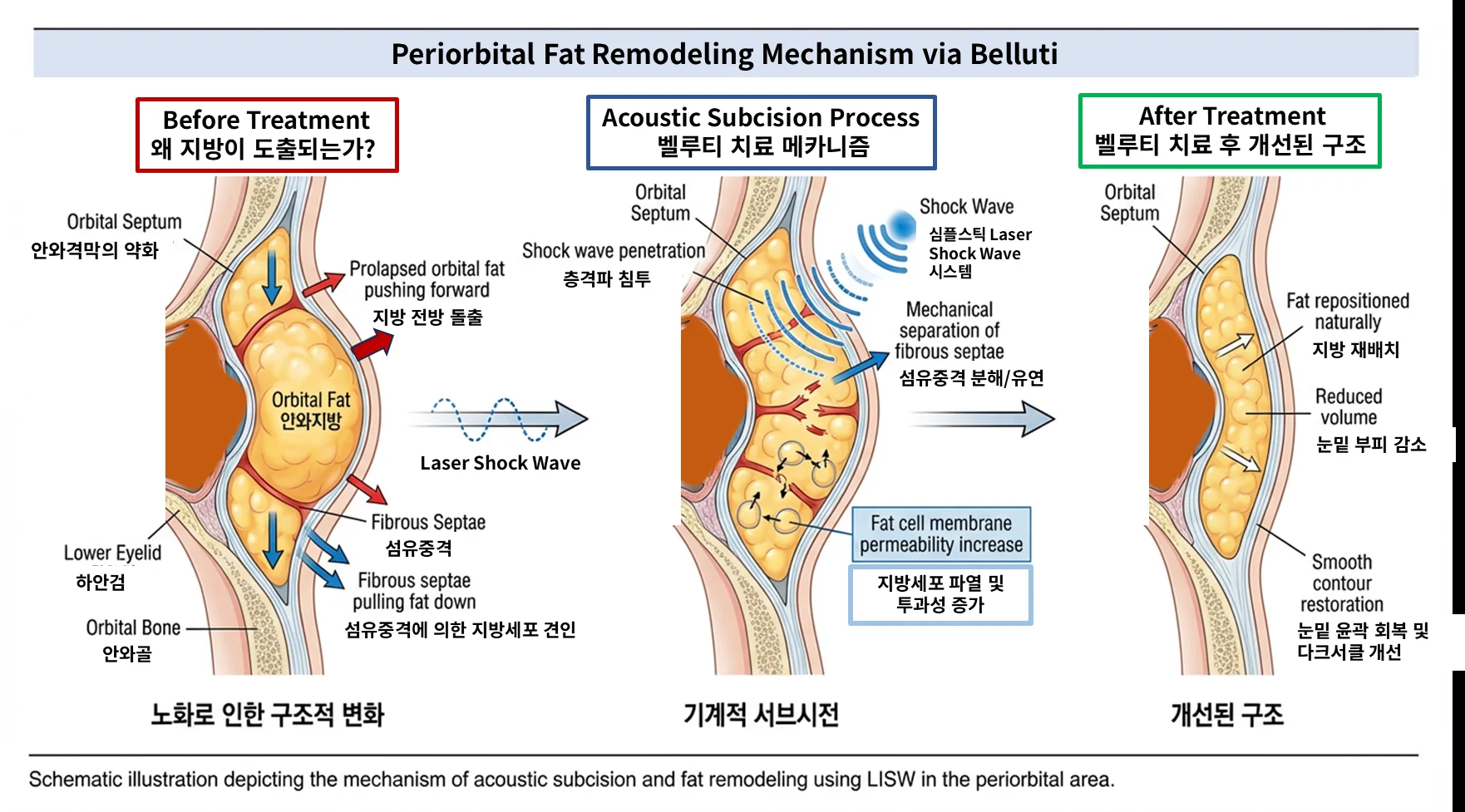 충격파에 의한 눈밑 지방 리모델링 기전