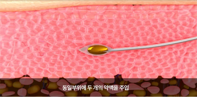진피층에 두 가지 약액을 주입하는 도식