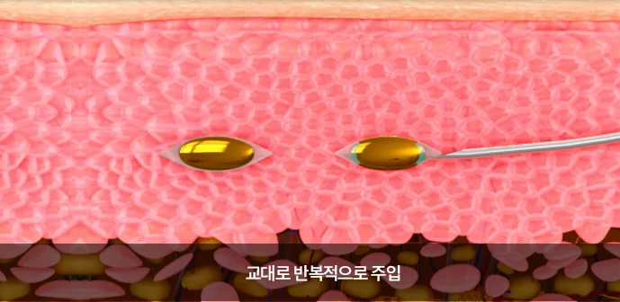 교대로 반복 주입하는 도식