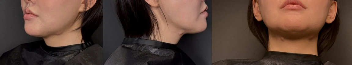 턱밑 실 시술 뒤 생긴 결절 — 관리 전
