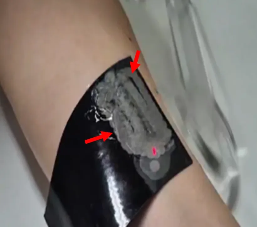 레이저가 닿은 범위가 그대로 남은 패치 — 관리 범위를 눈으로 확인