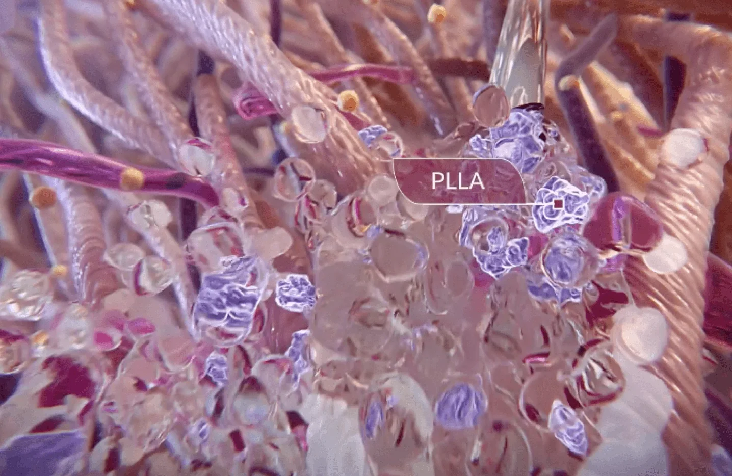 PLLA 가 콜라겐 생성을 자극하는 모습