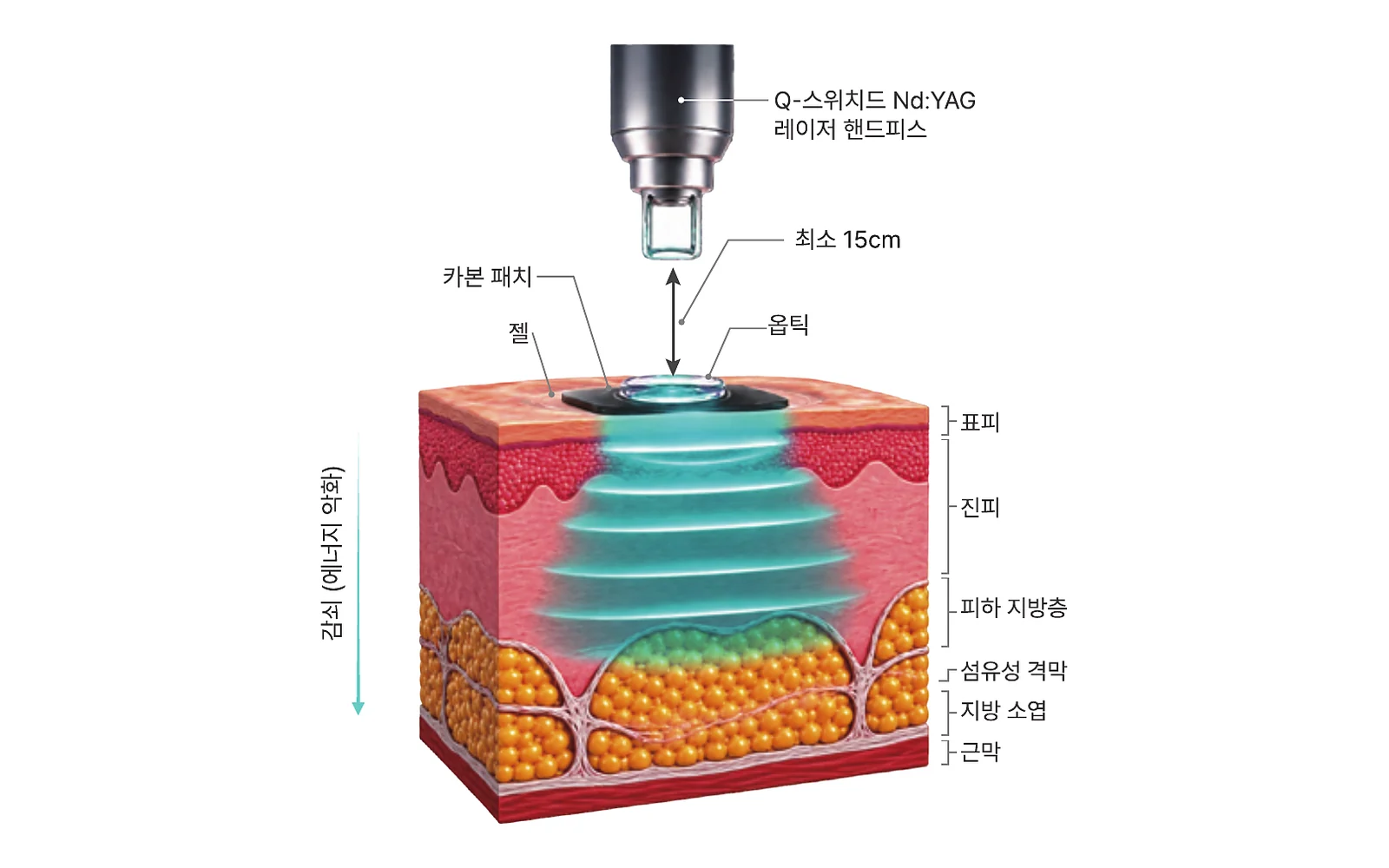 레이저가 카본 패치와 옵틱을 거쳐 압력 자극으로 피하 조직 방향에 전달되는 도식 · 샥코리아 자료