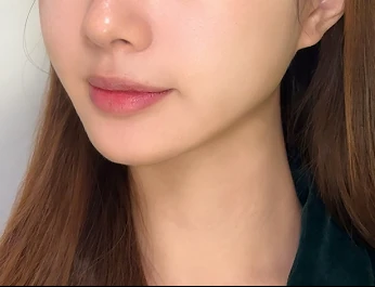 울쎄라피 프라임 턱선 · 옆모습 시술 후