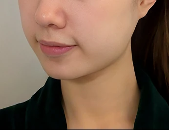 울쎄라피 프라임 턱선 · 옆모습 시술 전