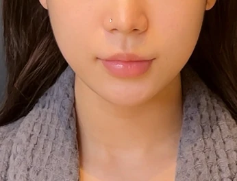 울쎄라피 프라임 얼굴 라인 · 정면 시술 후
