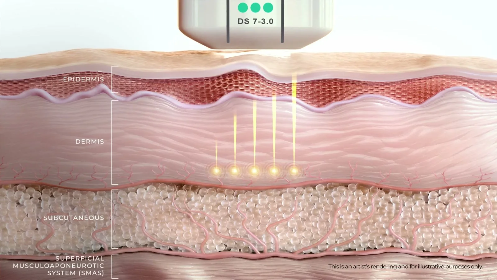 3.0mm 깊이 진피 깊은층
